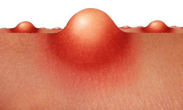 Bumps on the skin