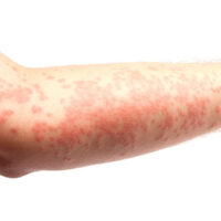 Eczema on an arm