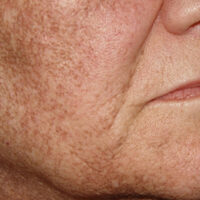 Hyper pigmentation on a woman's face