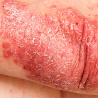 Psoriasis on an elbow