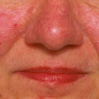 Rosacea on a woman's face