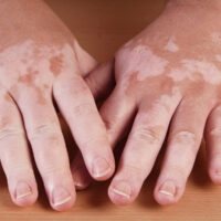 Vitiligo on the hands